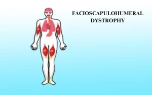 Facioscapulohumeral Muscular Dystrophy Treatment in Hyderabad