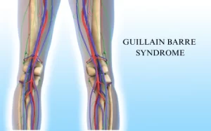 Guillain Barre Syndrome Treatment in Hyderabad