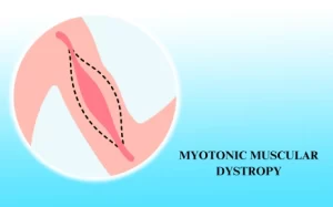 Myotonic Muscular Dystrophy Treatment in Hyderabad