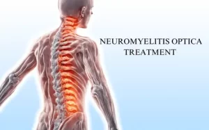 Neuromyelitis Optica Specialist in Hyderabad