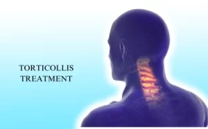Torticollis Treatment in Hyderabad